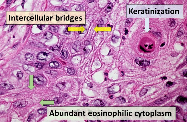 Keratinization