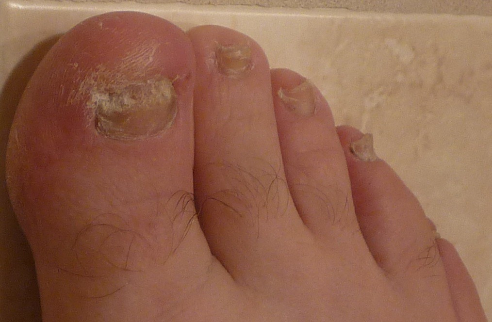 Onychomycosis