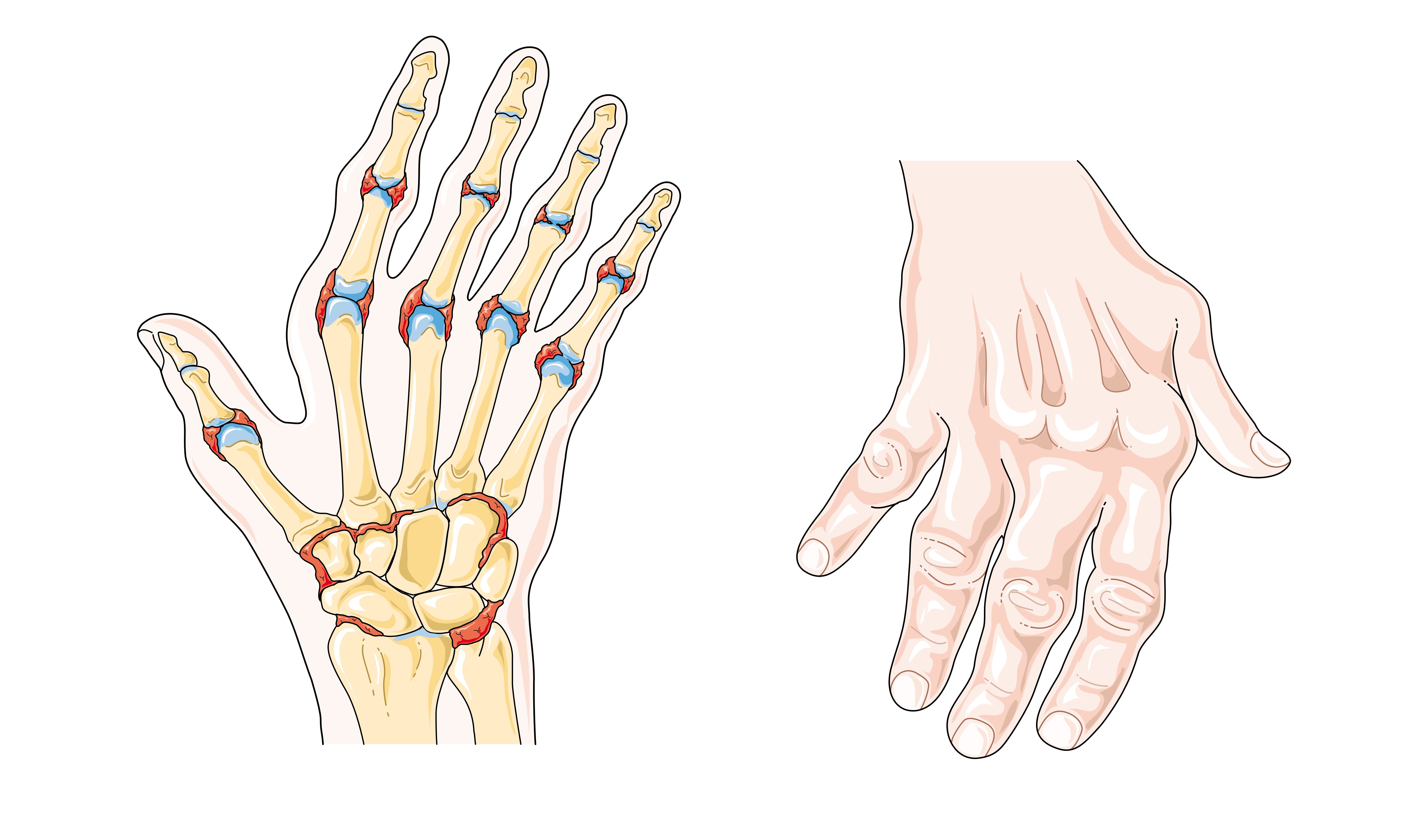 Rheumatoid arthritis