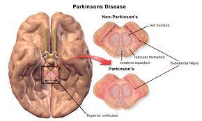 Parkinson's