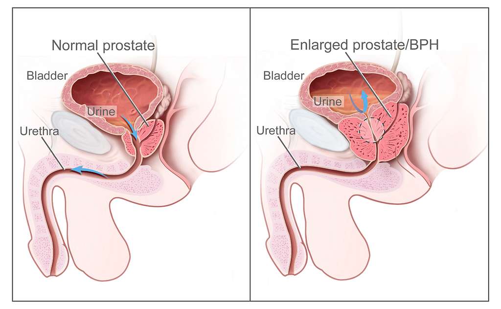 Benign prostatic Hyperplasia