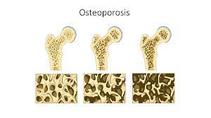 Osteoporosis