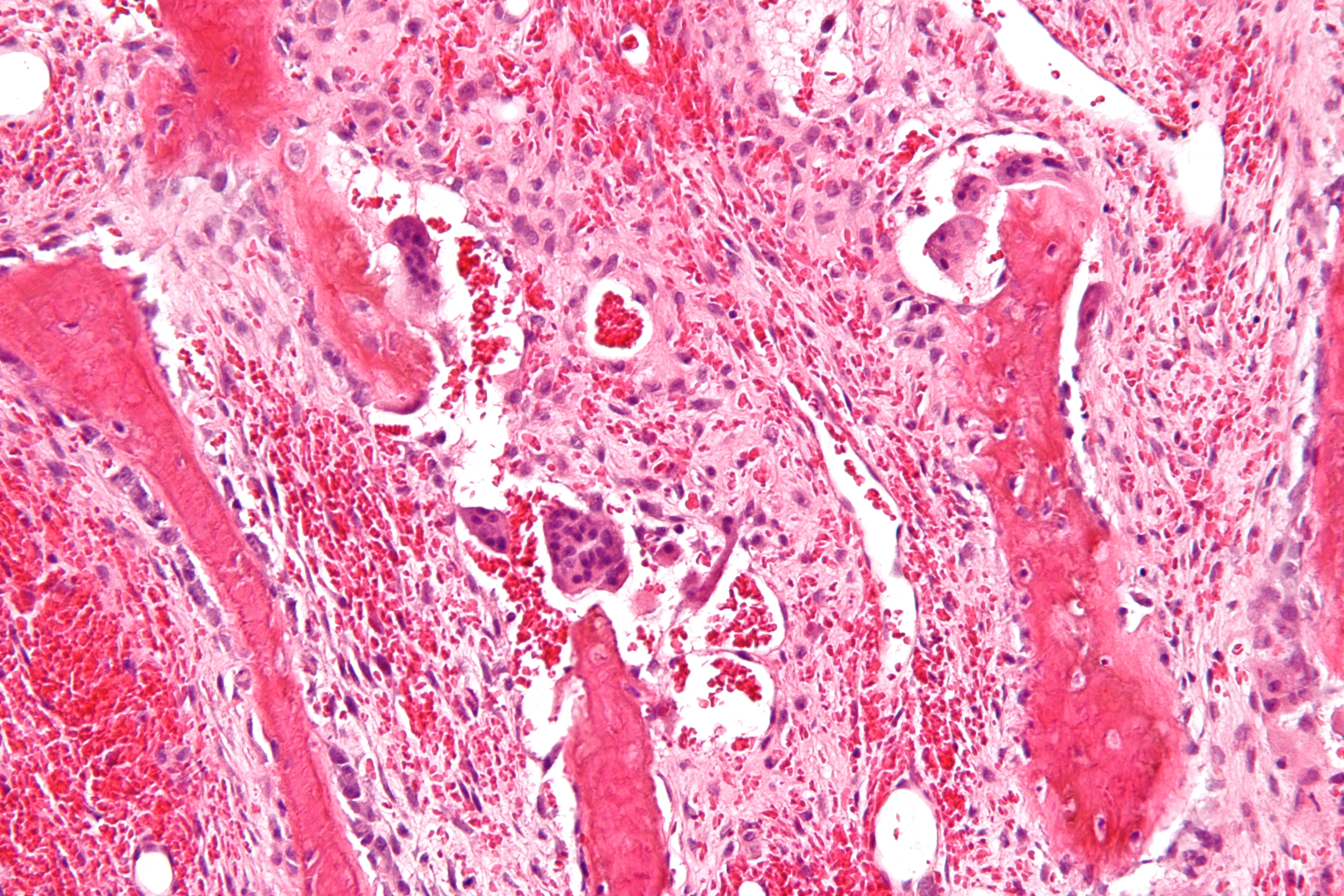 Bone-hypercalcemia