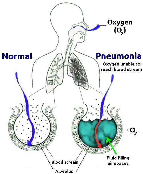 Pneumonia