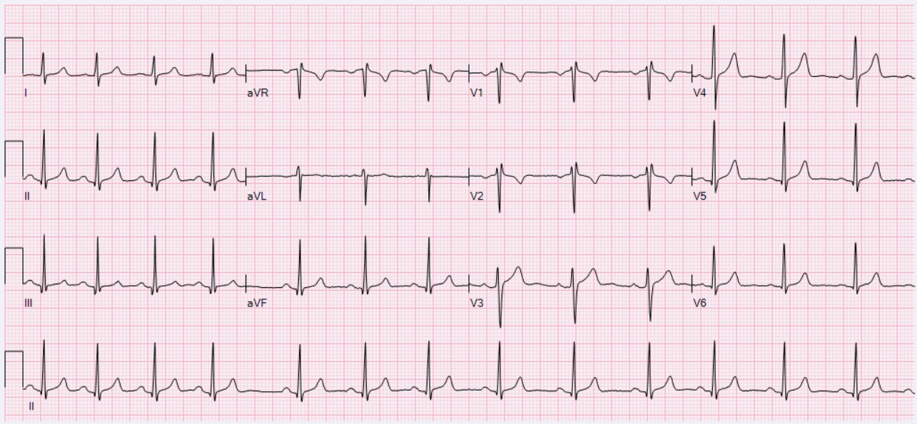 Irregular Heartbeat