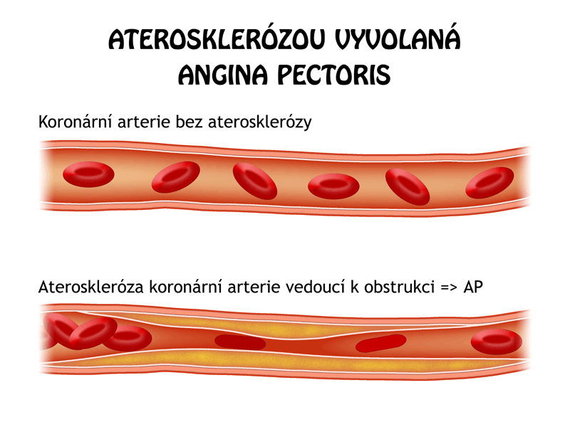 Angina Pectoris