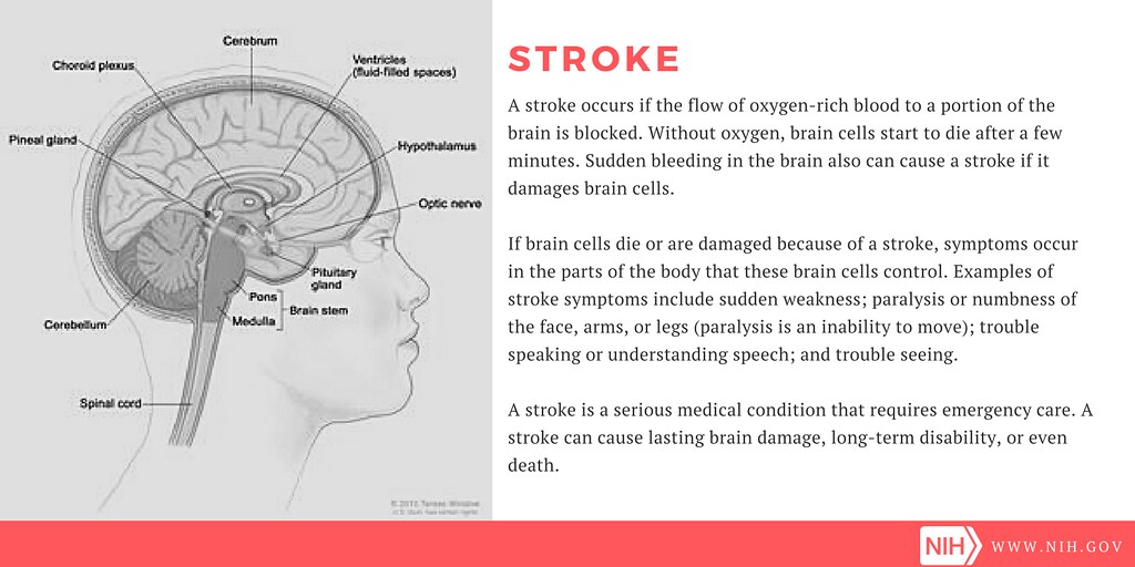 Stroke