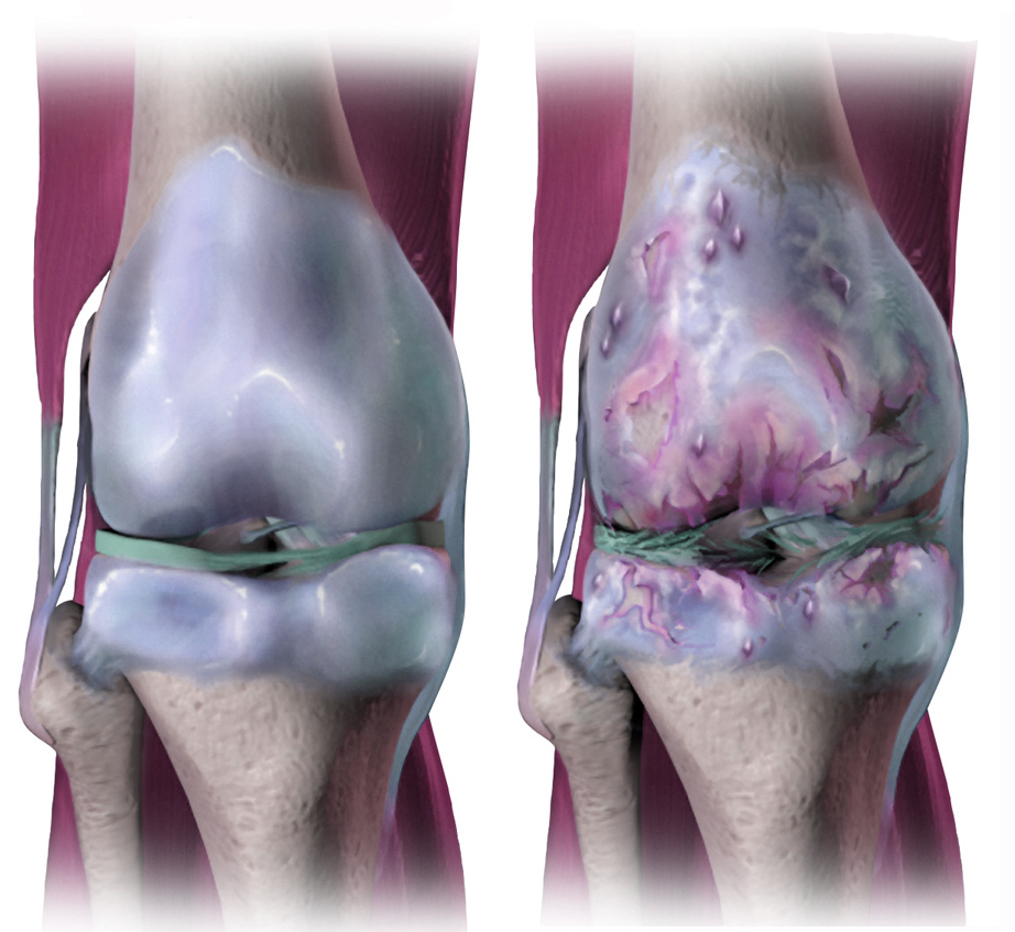 Osteoarthritis