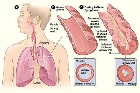 Asthma