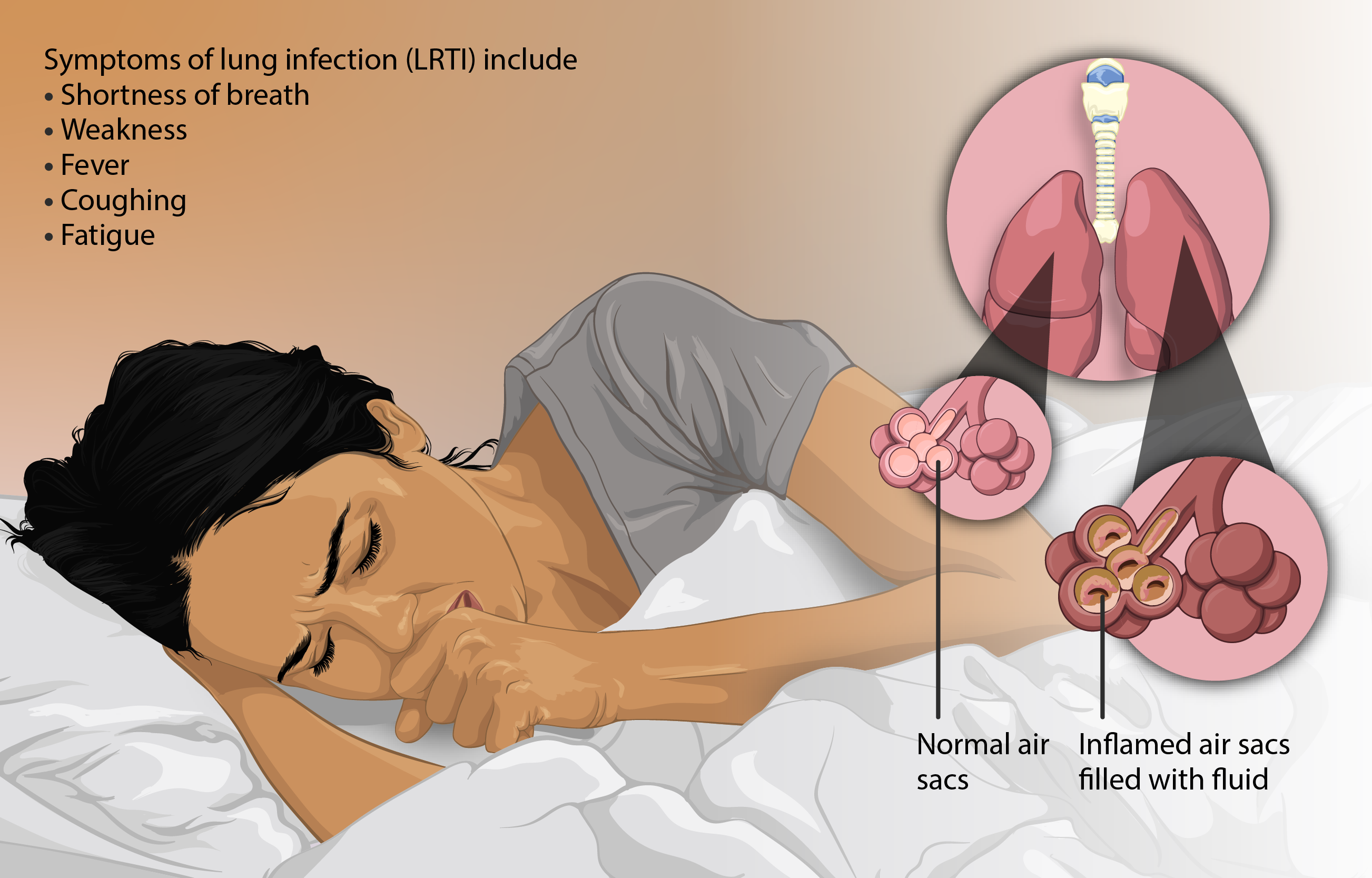 Respiratory tract infections 