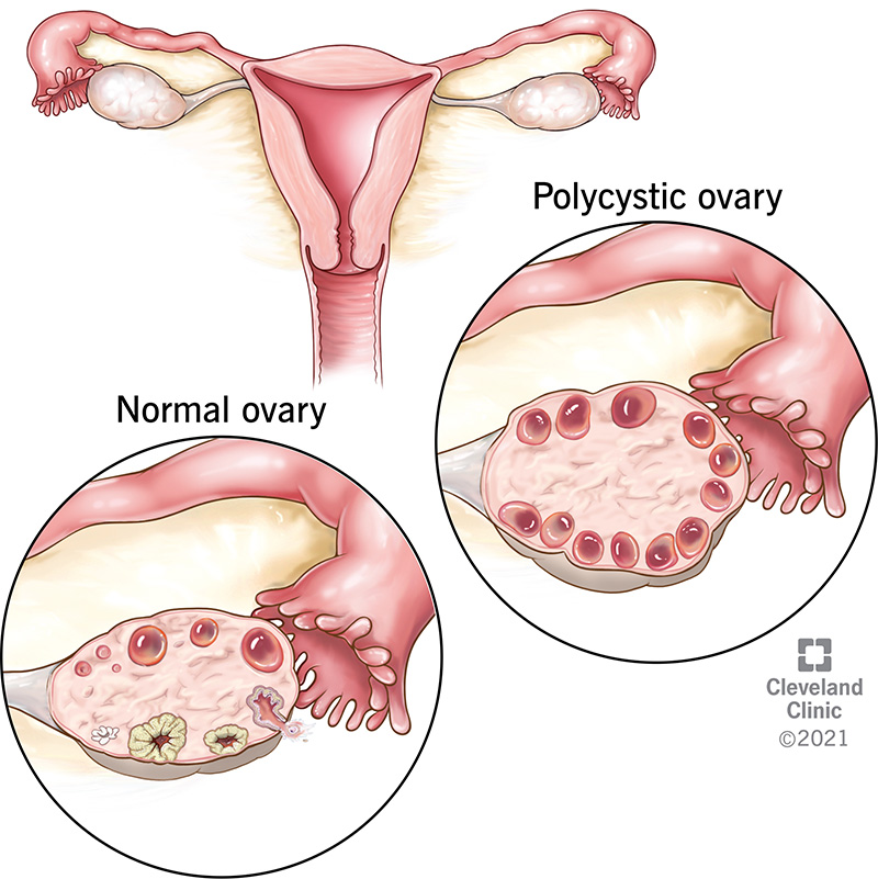 PCOS