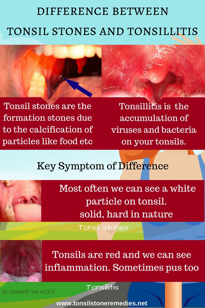 Tonsillitis