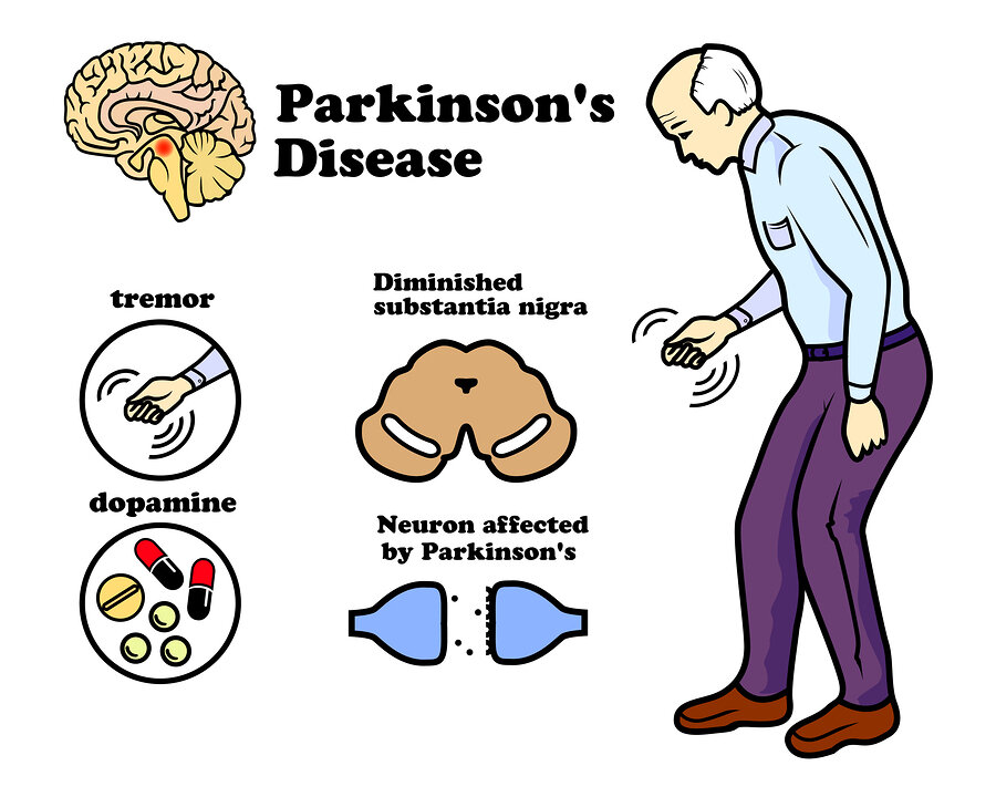 Parkinsons