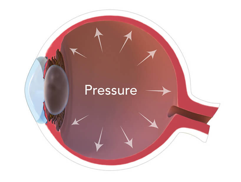 eye pressure