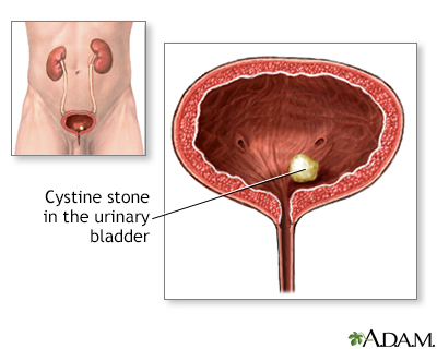 kidney stone