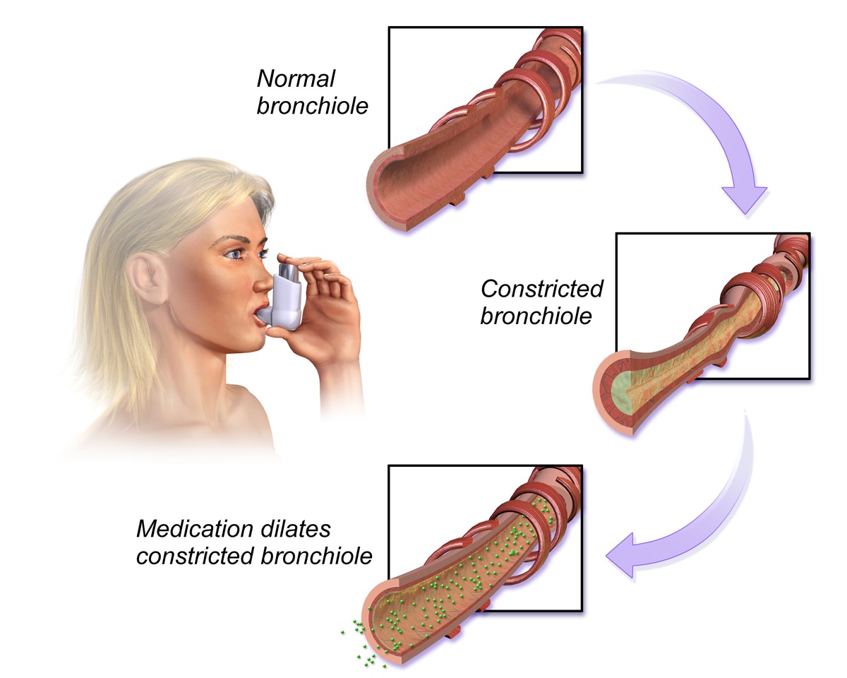 How a Bronchodilator works 