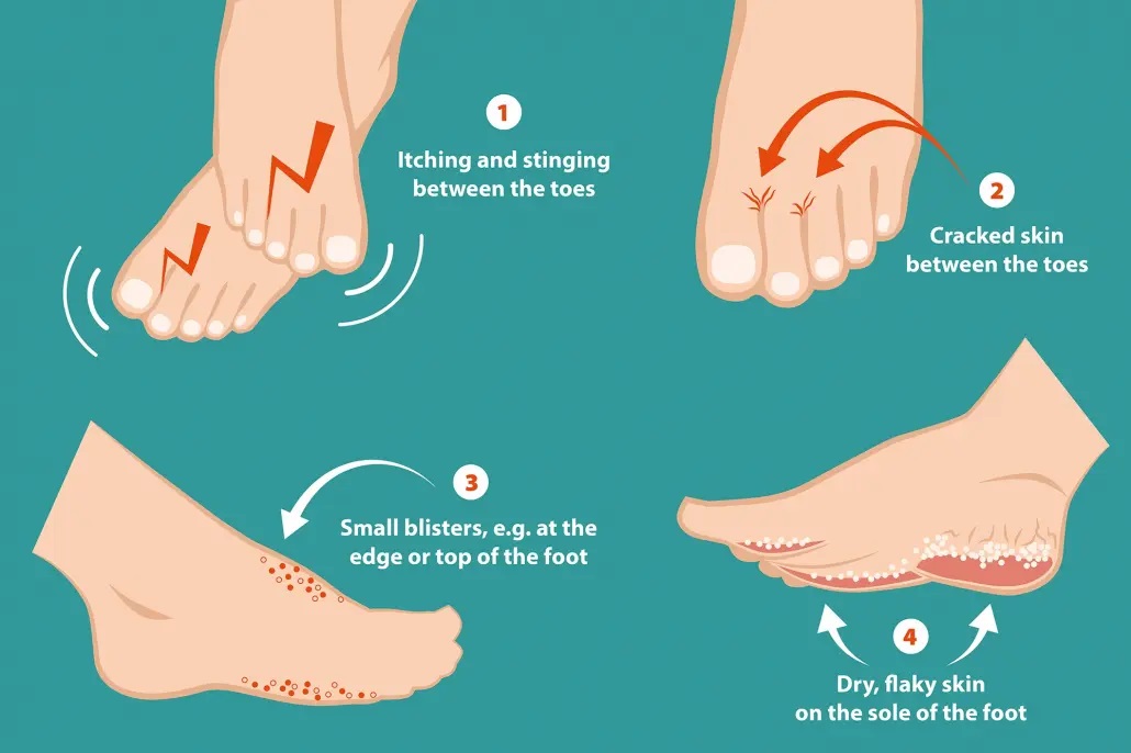 Athletes-foot