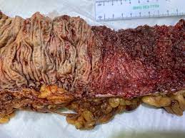 Severe Ulcerative Colitis