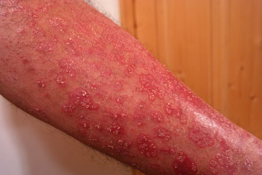 skin irritation