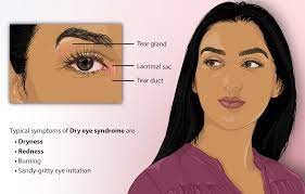 Dry-Eye-Disease