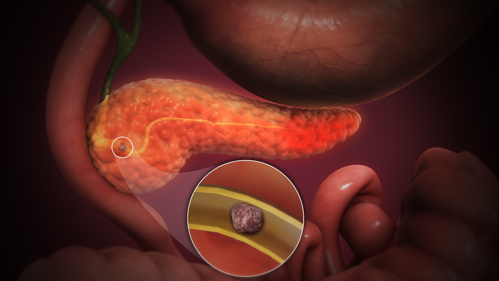 3D_Medical_Animation_Acute_Pancreatitis