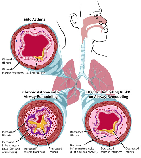 Mild Vs Chronic Asthma