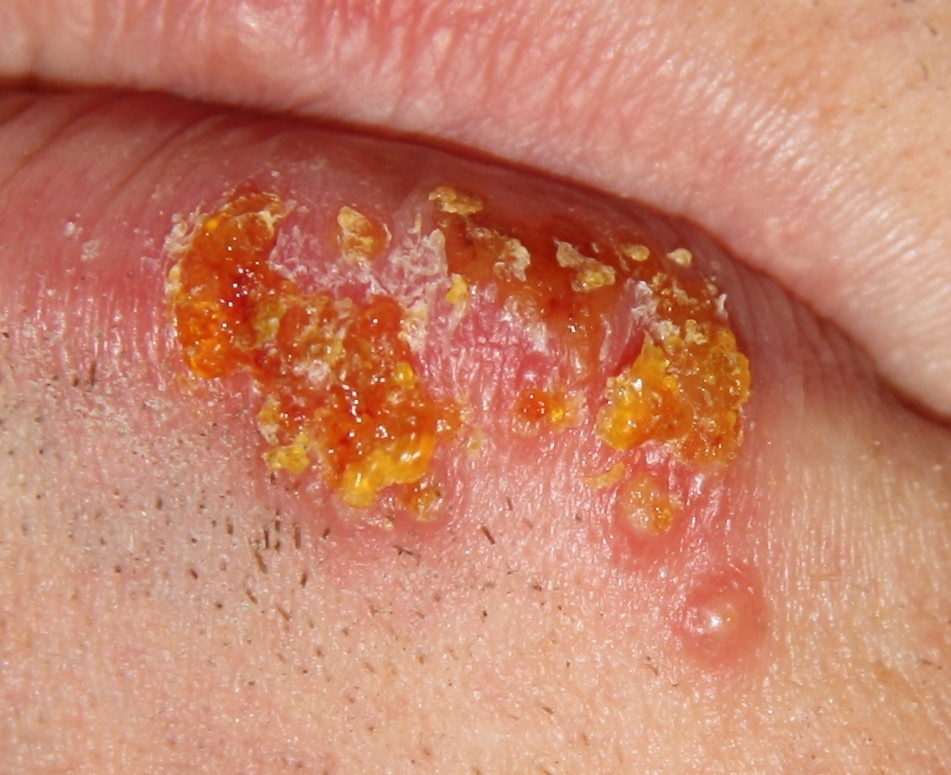 Lip Herpes Infection 
