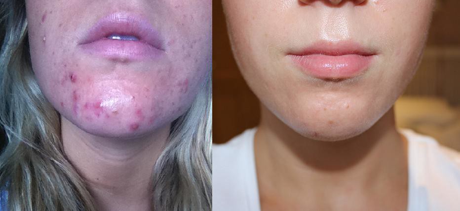 Acne before and after