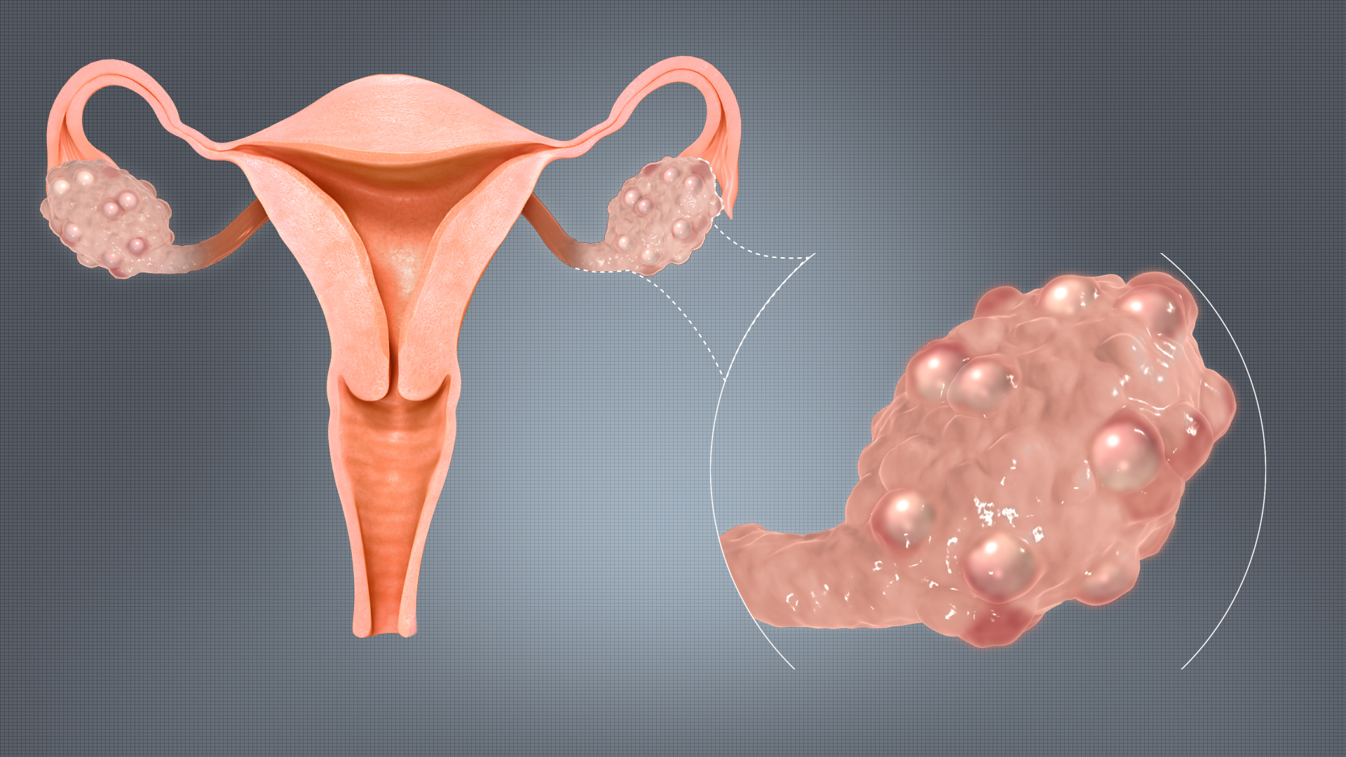 Polycystic-Ovary-Syndrome-(PCOS).